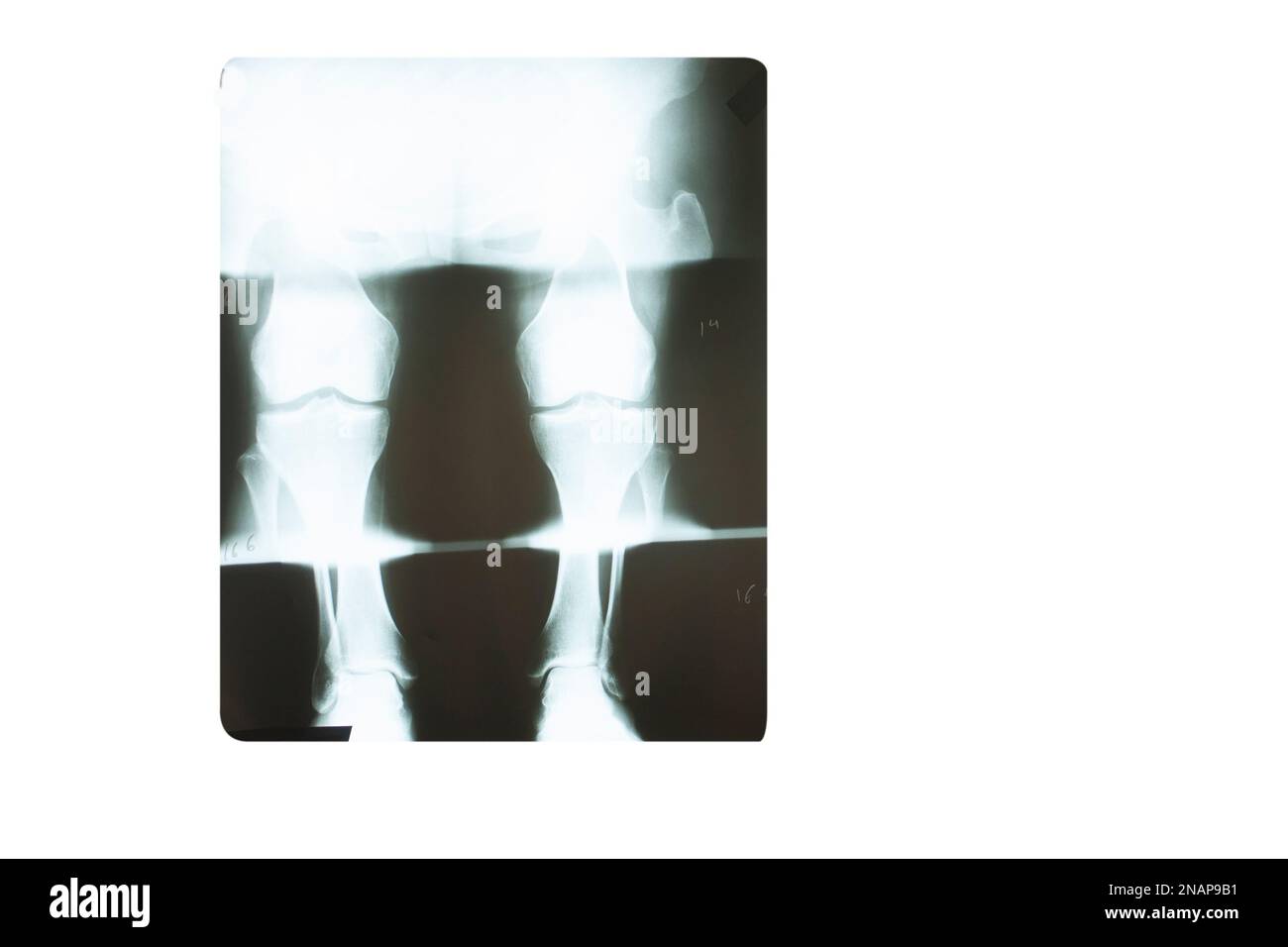 Legamenti crociati e ossa della cerniera con osservazione atipica della formazione immagine radiografica dell'area ginocchio-fibula Foto Stock