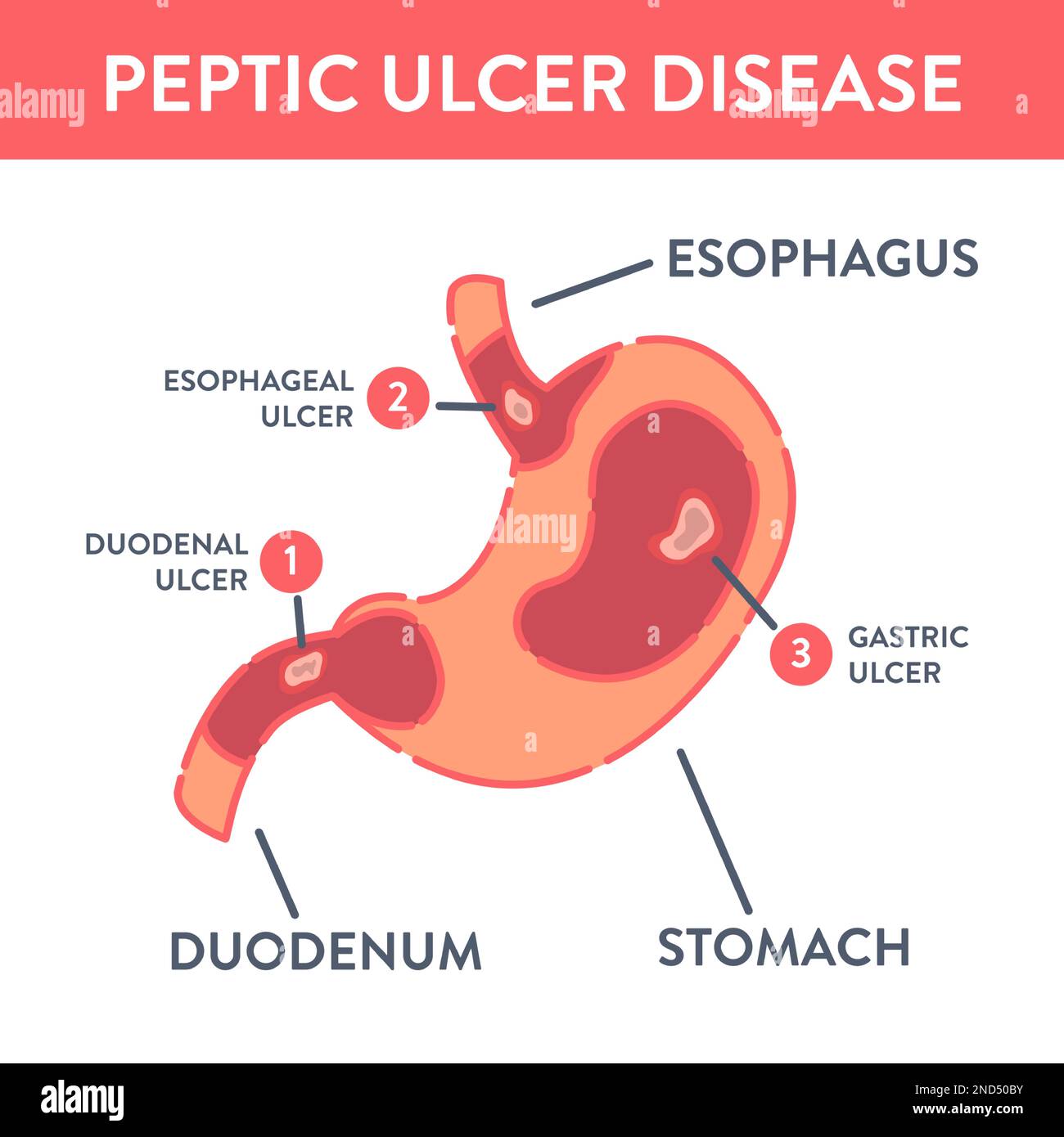 Infografica medica con tipi di ulcera peptica malattia dello stomaco Illustrazione Vettoriale