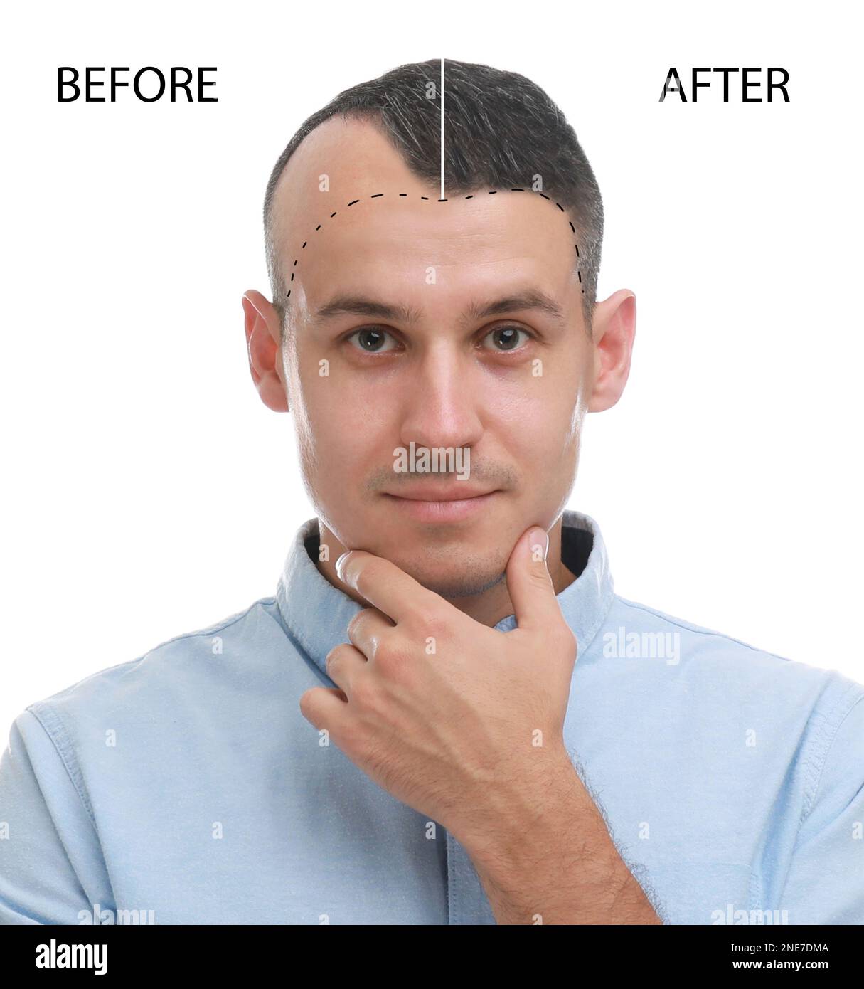 Uomo prima e dopo il trattamento di perdita dei capelli su sfondo bianco, collage Foto Stock