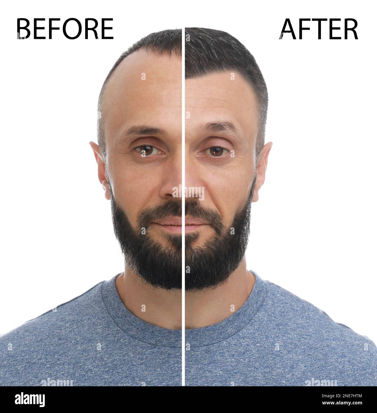Uomo prima e dopo il trattamento di perdita dei capelli su sfondo bianco, collage Foto Stock