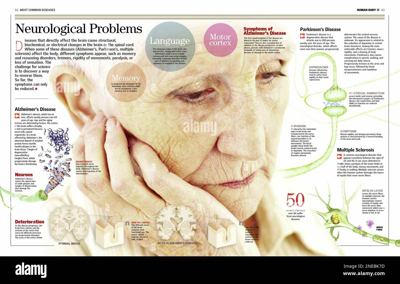 Illustra i disturbi neurologici più comuni con immagini di microtubuli nei neuroni attaccati da placche senili, e una sezione sana e uno colpito nel caso del cervello di Alzheimer, e la rottura delle sinapsi neuronali nel Parkinson. Inoltre comprende l'attacco di macrofagi del sistema immunitario contro il tessuto nervoso mielino nel caso di sclerosi multipla. [6259x4015]. Foto Stock