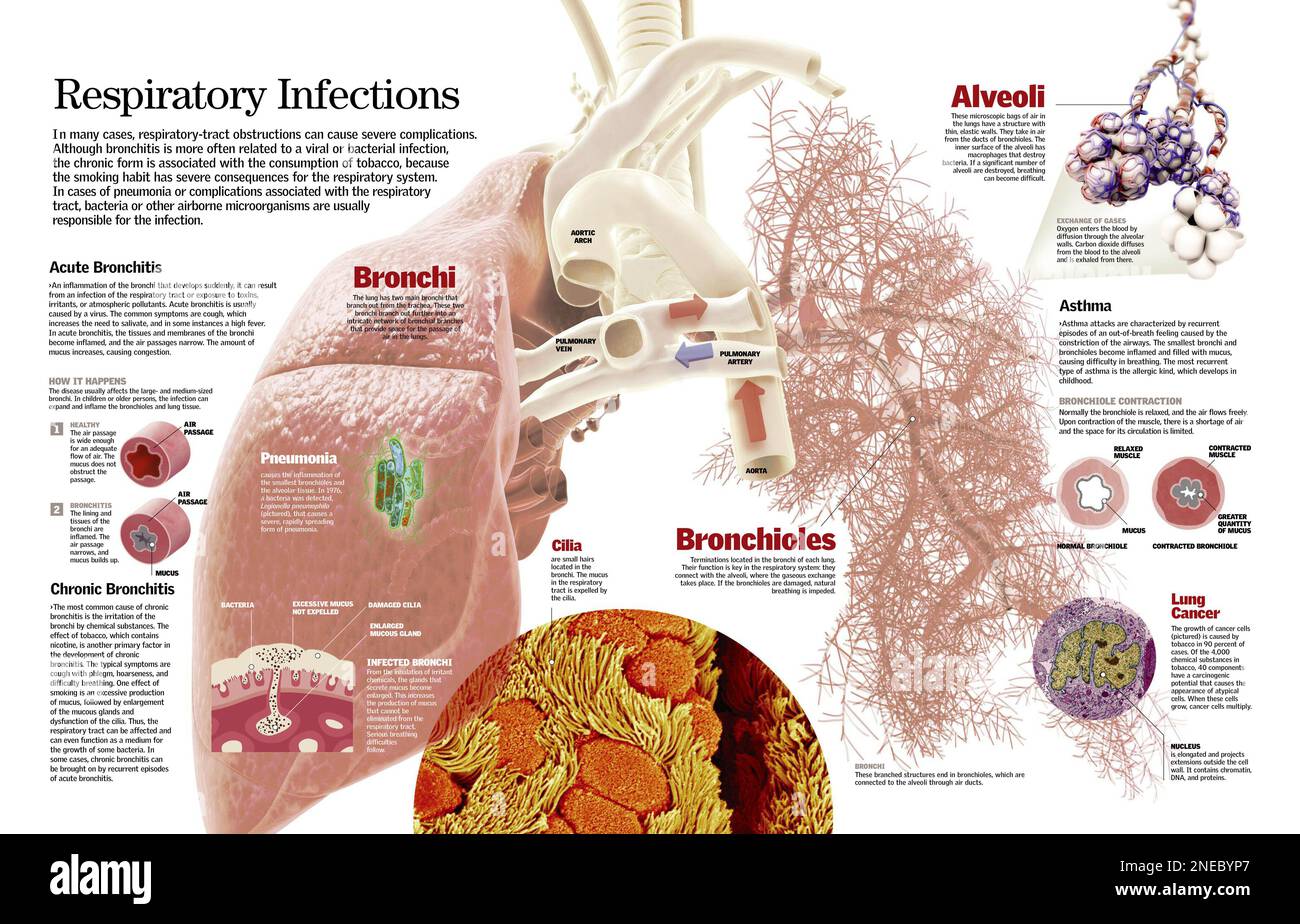 Infografica delle principali illnesi respiratorie come bronchite, asma e cancro polmonare. [QuarkXPress (.qxp); 6259x4015]. Foto Stock