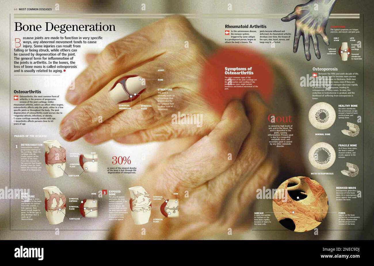 Infografica dedicata alle principali malattie ossee: Osteoartrite, artrite reumatoide, osteoporosi e gotta. Illustrando le fasi di deterioramento dell'osteoartrite, offre una radiografia di una mano affetta da artrite reumatoide, e mostra sezioni di un osso sano e altre affette da osteoporosi. [6259x4015]. Foto Stock