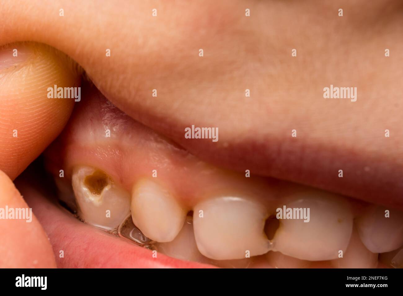 foto ravvicinata dei denti con carie Foto Stock