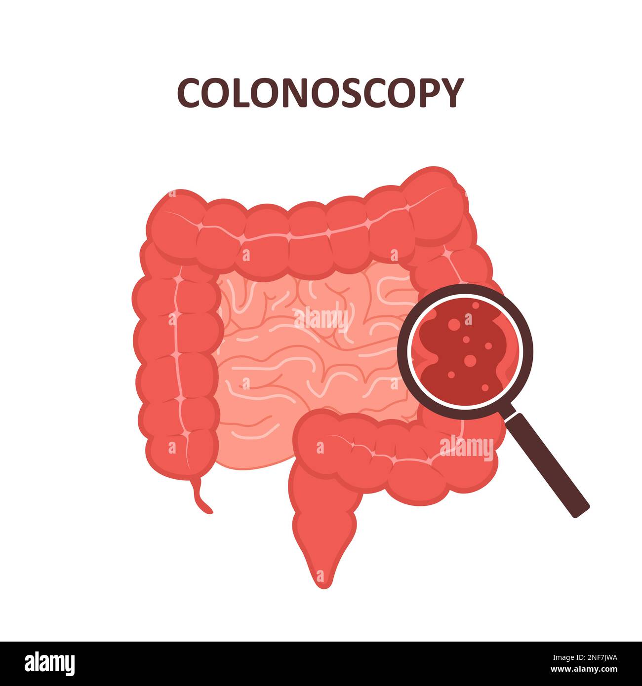Concetto di colonscopia. Esame e trattamento dell'intestino. Procedura di polipectomia del colon. Prevenzione del cancro. Illustrazione vettoriale in stile cartoon piatto Illustrazione Vettoriale