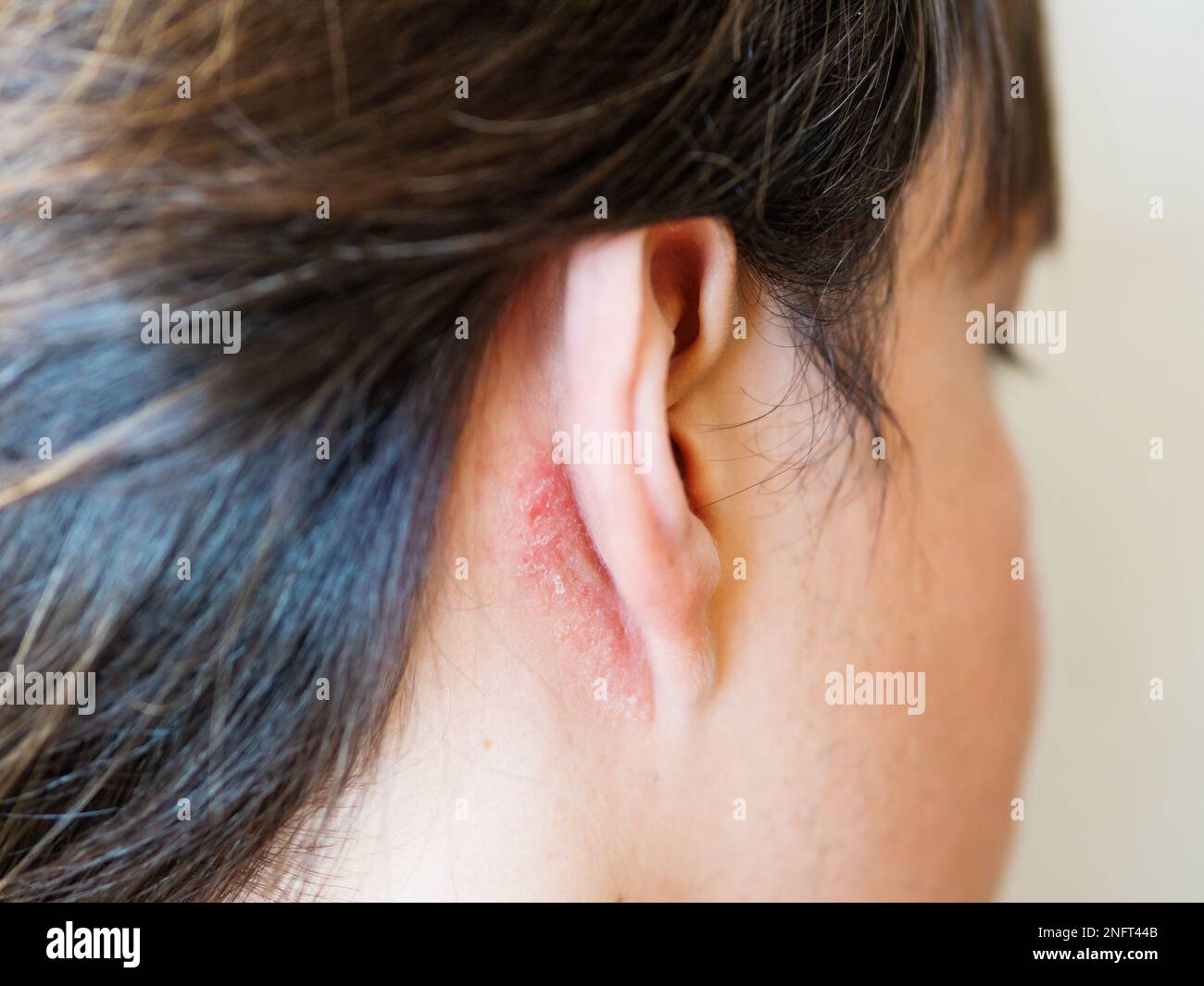 Irritazione della pelle dietro l'orecchio. Uomo con pelle traballante. Allergia o malattia fungina. Foto Stock