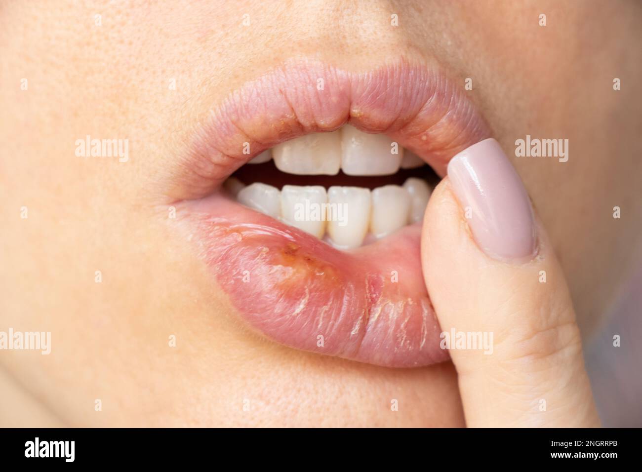 Herpes simplex sulle labbra di una ragazza primo piano, un gruppo di malattie virali con una eruzione caratteristica di vescicole raggruppate sul labbro Foto Stock