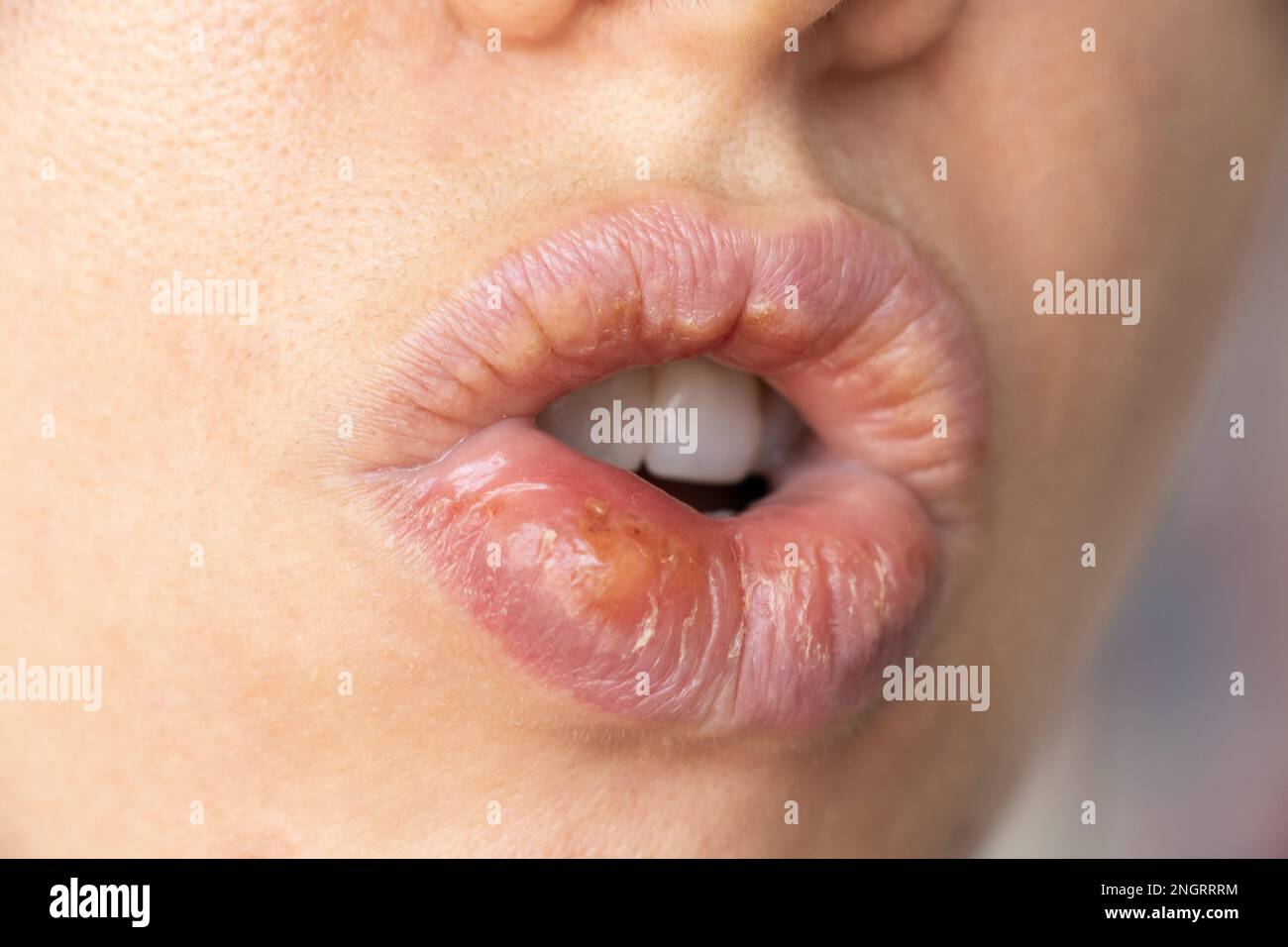 Herpes simplex sulle labbra di una ragazza primo piano, un gruppo di malattie virali con una eruzione caratteristica di vescicole raggruppate sul labbro Foto Stock