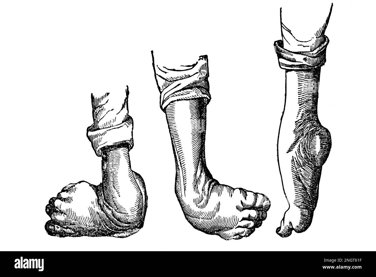 Deformità del piede. Antica illustrazione da un libro medico. 1889. Foto Stock