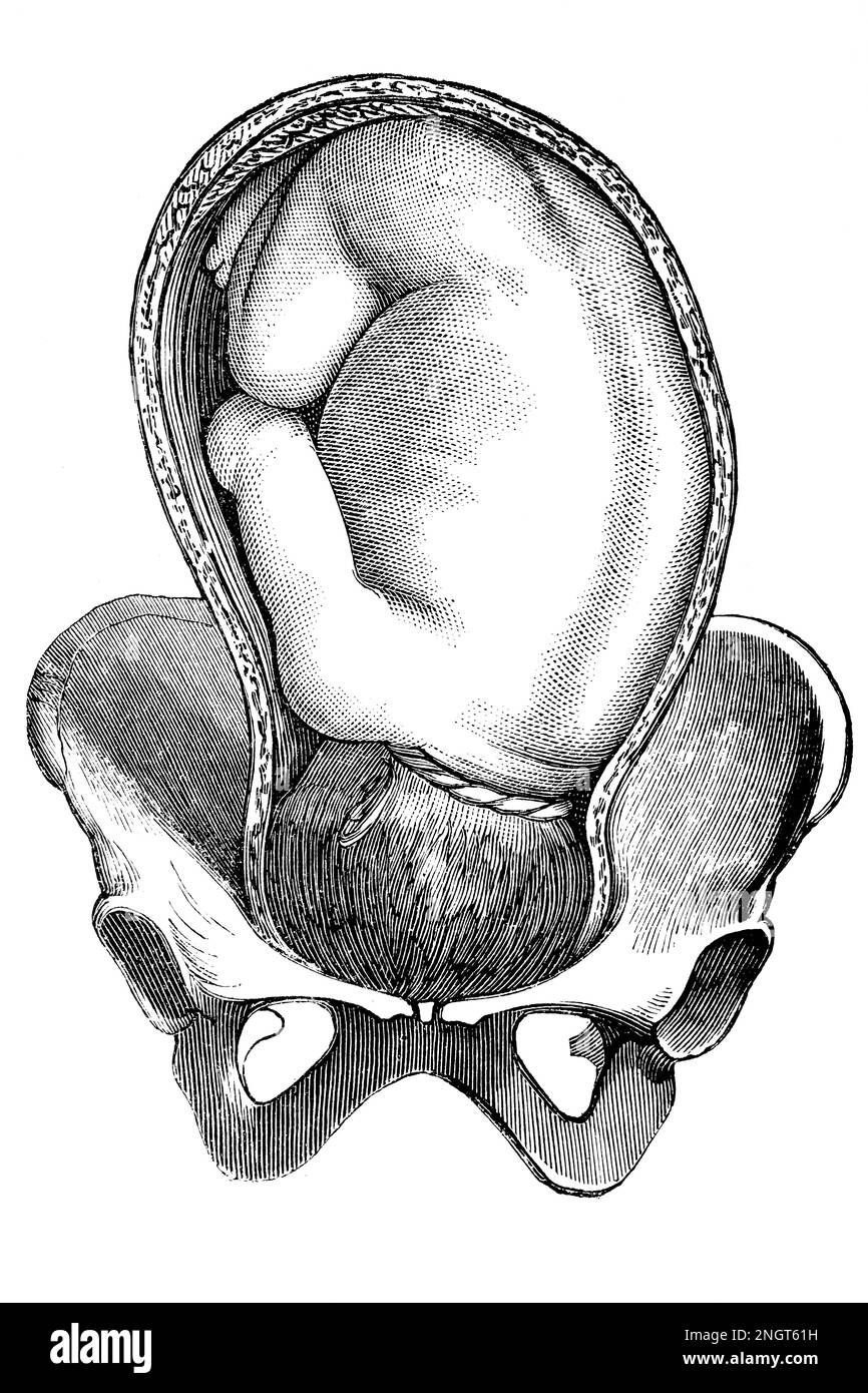 Prolasso del cordone ombelicale. Antica illustrazione da un libro medico. 1889. Foto Stock