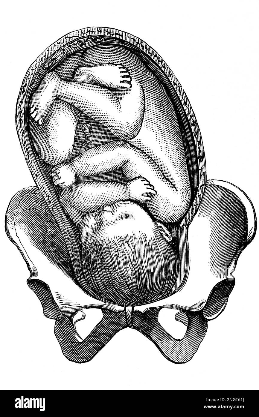 Nascita successiva. Il bambino nel grembo. Antica illustrazione da un libro medico. 1889. Foto Stock
