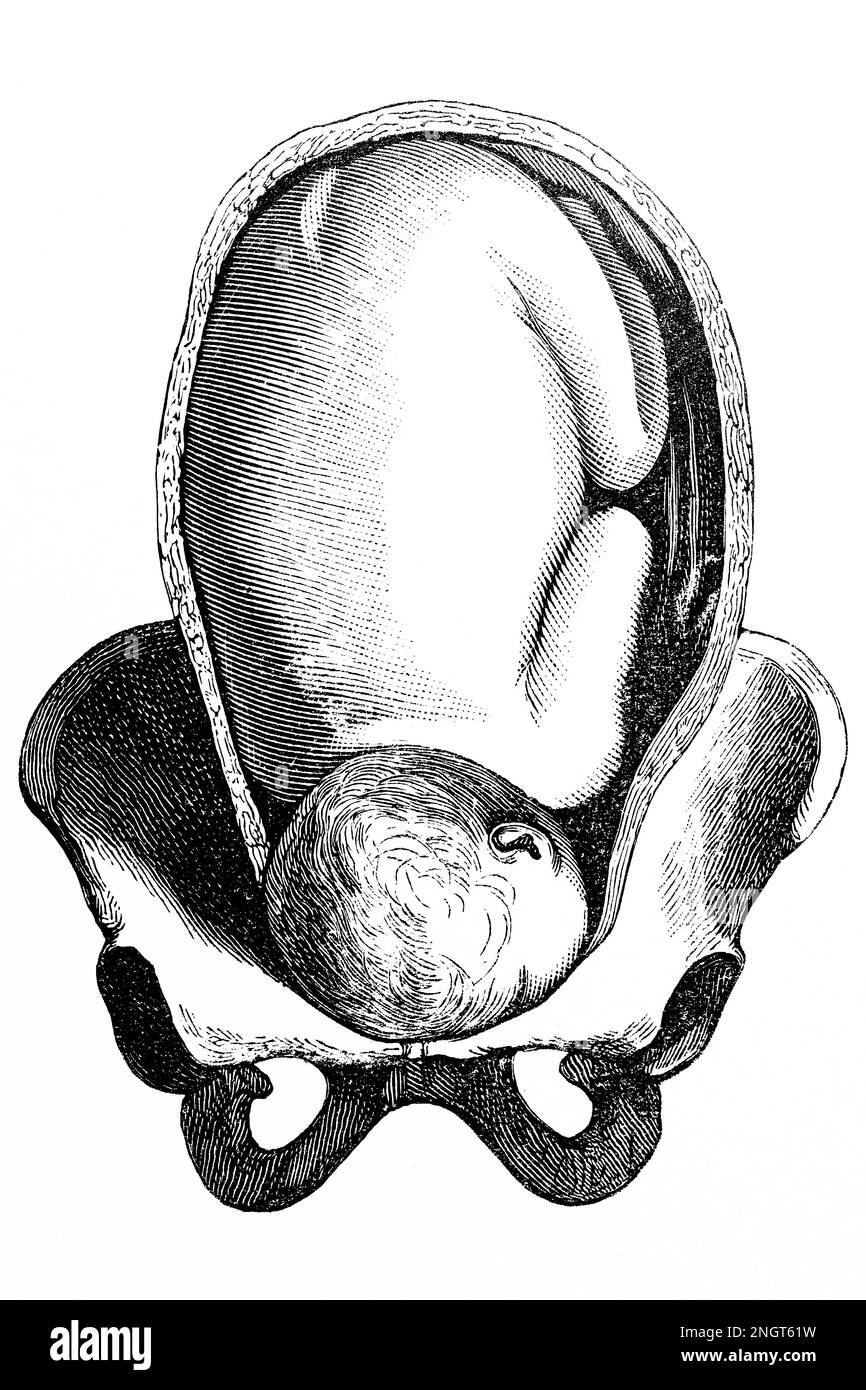 Posizione anomala del feto. Presentazione del volto. Antica illustrazione da un libro medico. 1889. Foto Stock