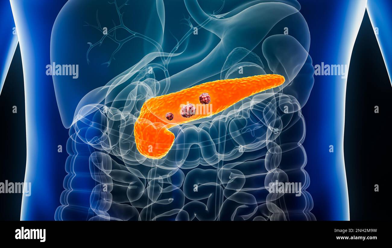 Pancreas o cancro pancreatico con organi e tumori o cellule cancerose 3D che rendono illustrazione con il corpo maschile. Anatomia, oncologia, malattia, medico, Foto Stock