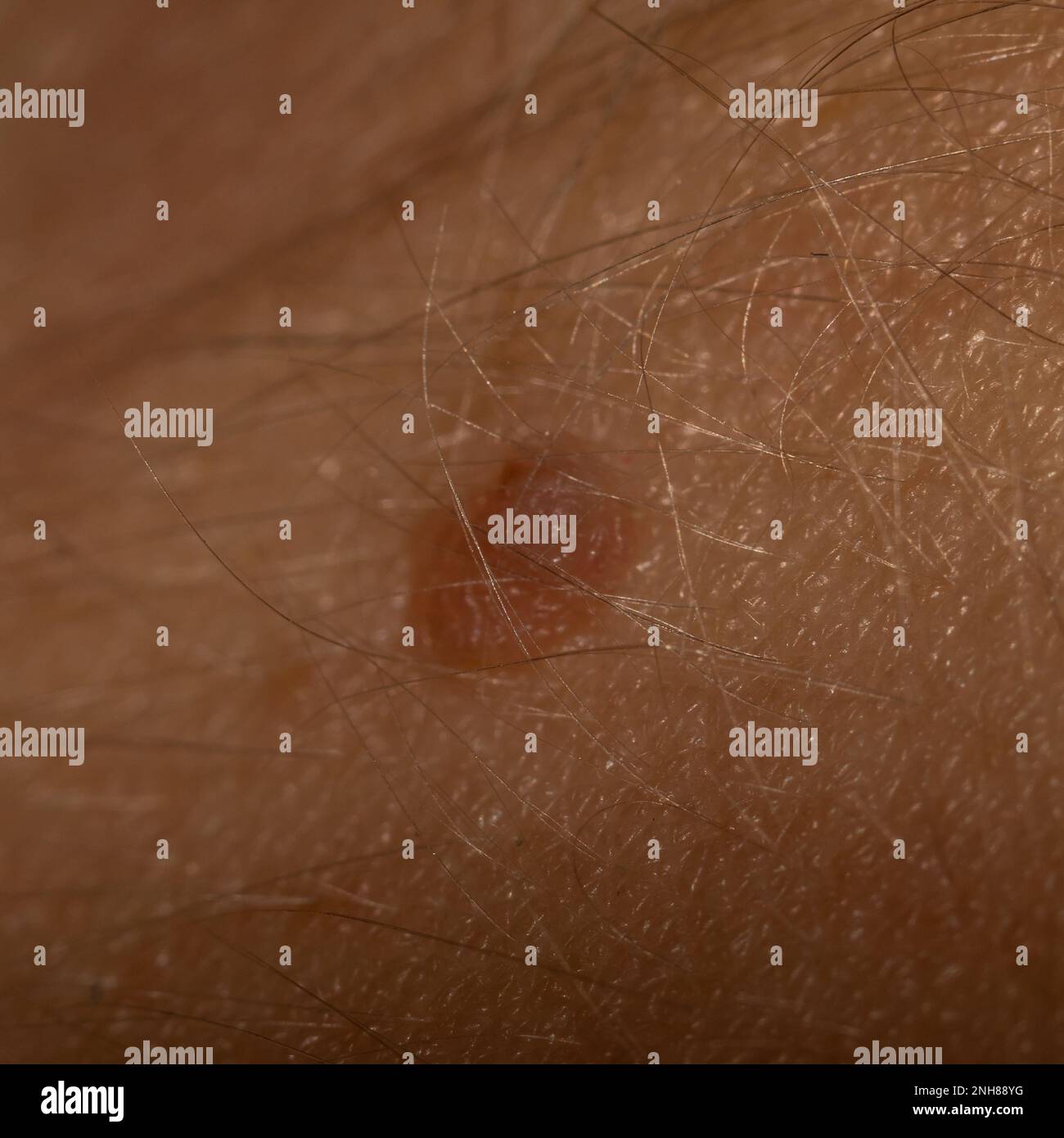 Mole, foto macro sulla pelle umana. Primo piano Foto Stock