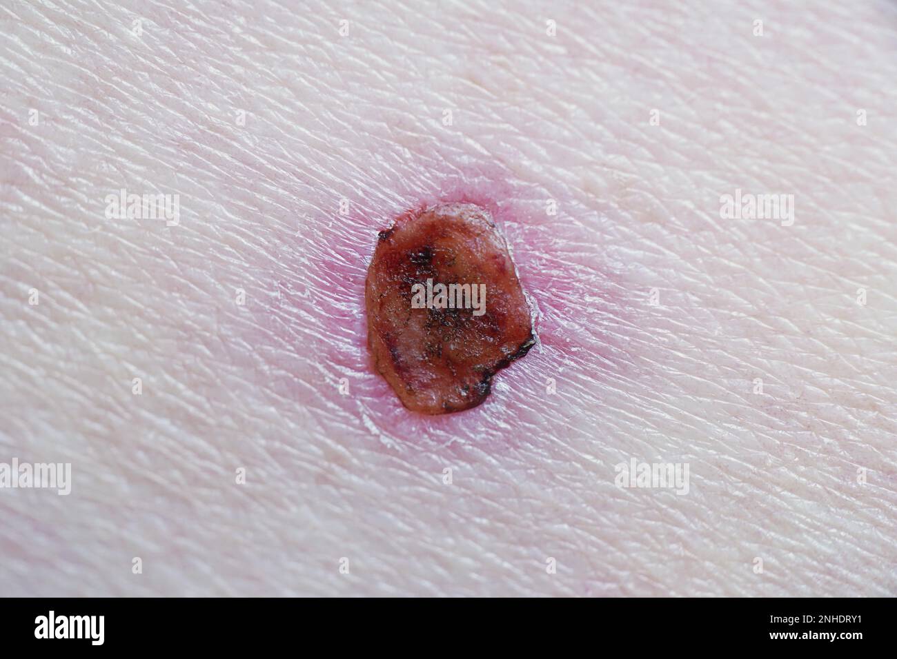 guarigione della ferita con scab dopo trattamento laser del cancro della pelle delle cellule basali Foto Stock