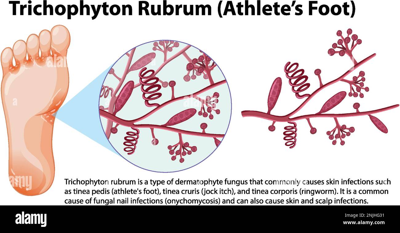 Trichophyton rubrum infezione fungal illustrazione Illustrazione Vettoriale