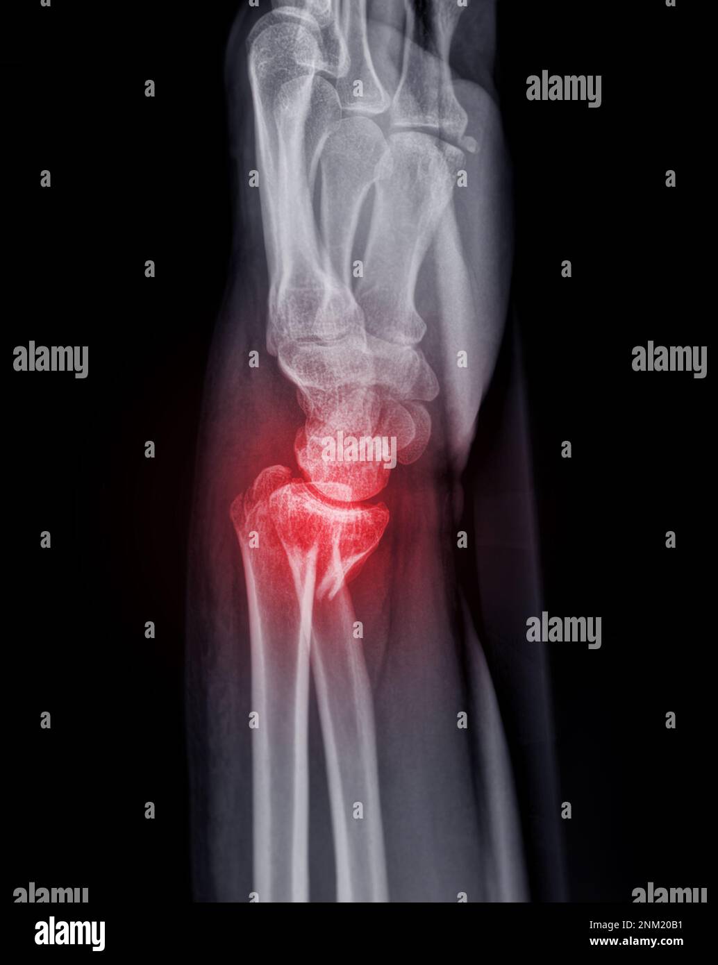 Immagine radiografica dell'articolazione del polso sinistro AP e vista laterale per la visualizzazione della frattura dell'osso radiale. Foto Stock
