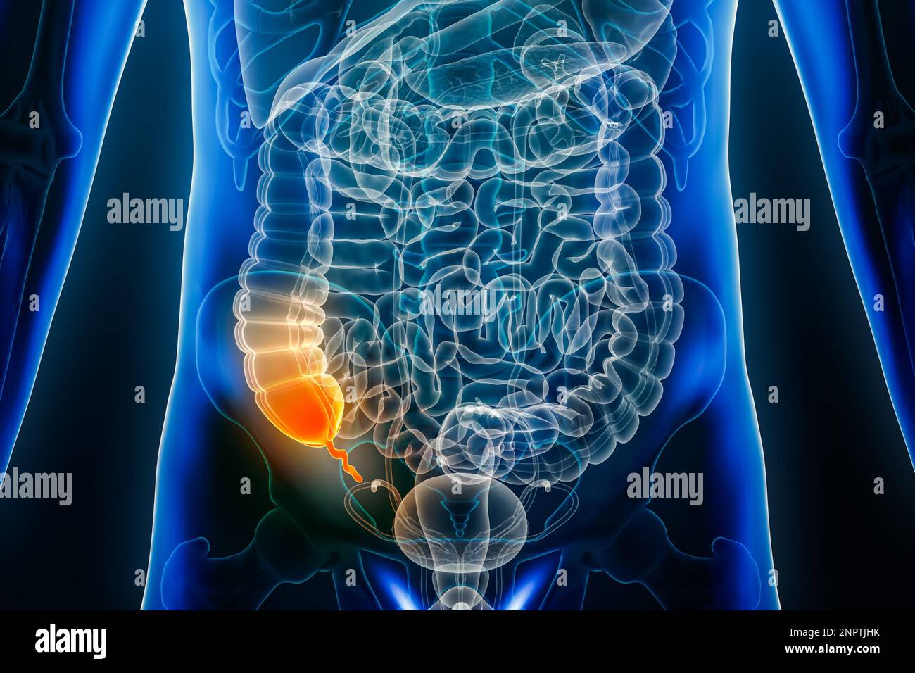 Malattia di appendicite o infiammazione di appendice vermiforme 3D che rende l'illustrazione vista anteriore o anteriore. Anatomia, chirurgia, biomedica, malattia, medicina Foto Stock Malattia di appendicite o infiammazione di appendice vermiforme 3D che rende l'illustrazione vista anteriore o anteriore. Anatomia, chirurgia, biomedica, malattia, medicina Foto Stock