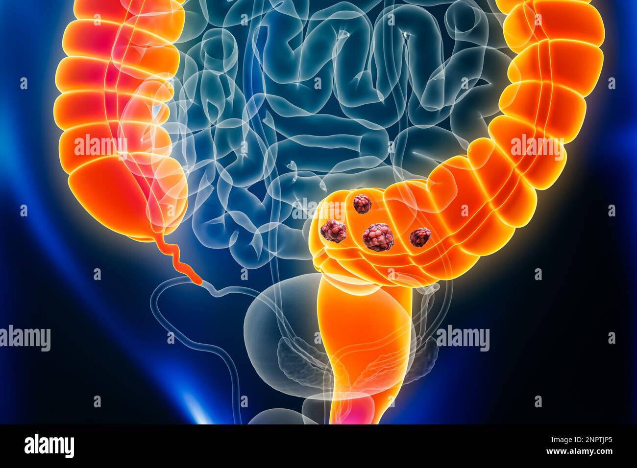 Cancro del colon o dell'intestino crasso con organi e tumori o cellule cancerose 3D che rendono illustrazione. Anatomia, oncologia, malattie intestinali, medico, biolo Foto Stock