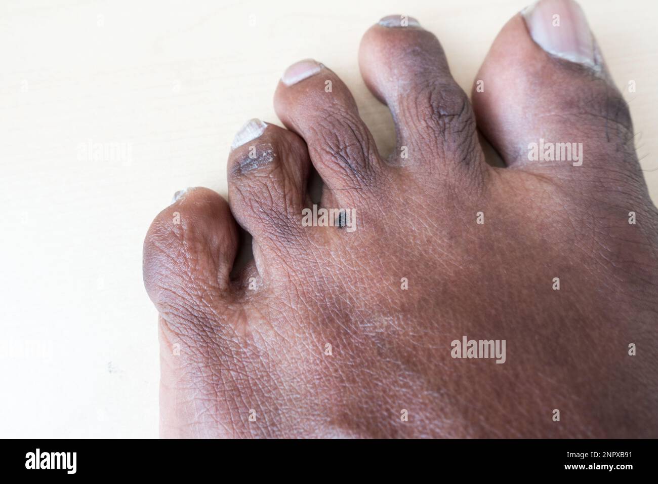 Birthmark tra le dita dei piedi Foto Stock