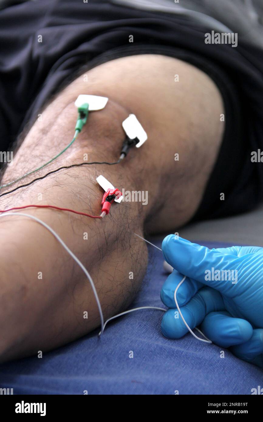 Elettromiografia EMG e potenziale evocato somatosensoriale PEV delle ...