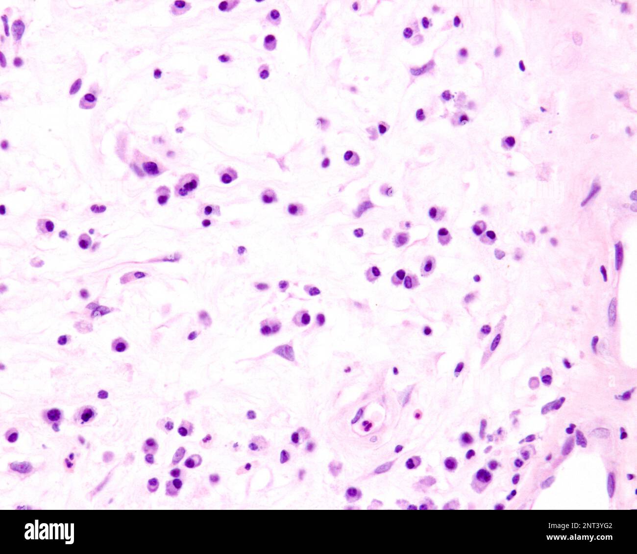 Le cellule plasmatiche sono linfociti B attivati dalla presenza di antigeni che secernono grandi quantità di anticorpi. Compaiono nei tessuti affetti da c Foto Stock