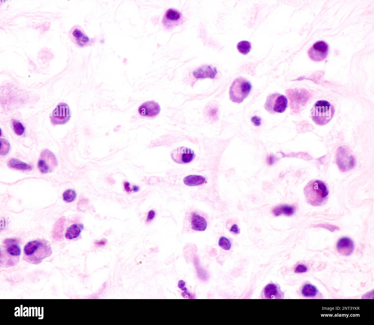 Le cellule plasmatiche sono linfociti B attivati dalla presenza di antigeni che secernono grandi quantità di anticorpi. Compaiono nei tessuti affetti da c Foto Stock