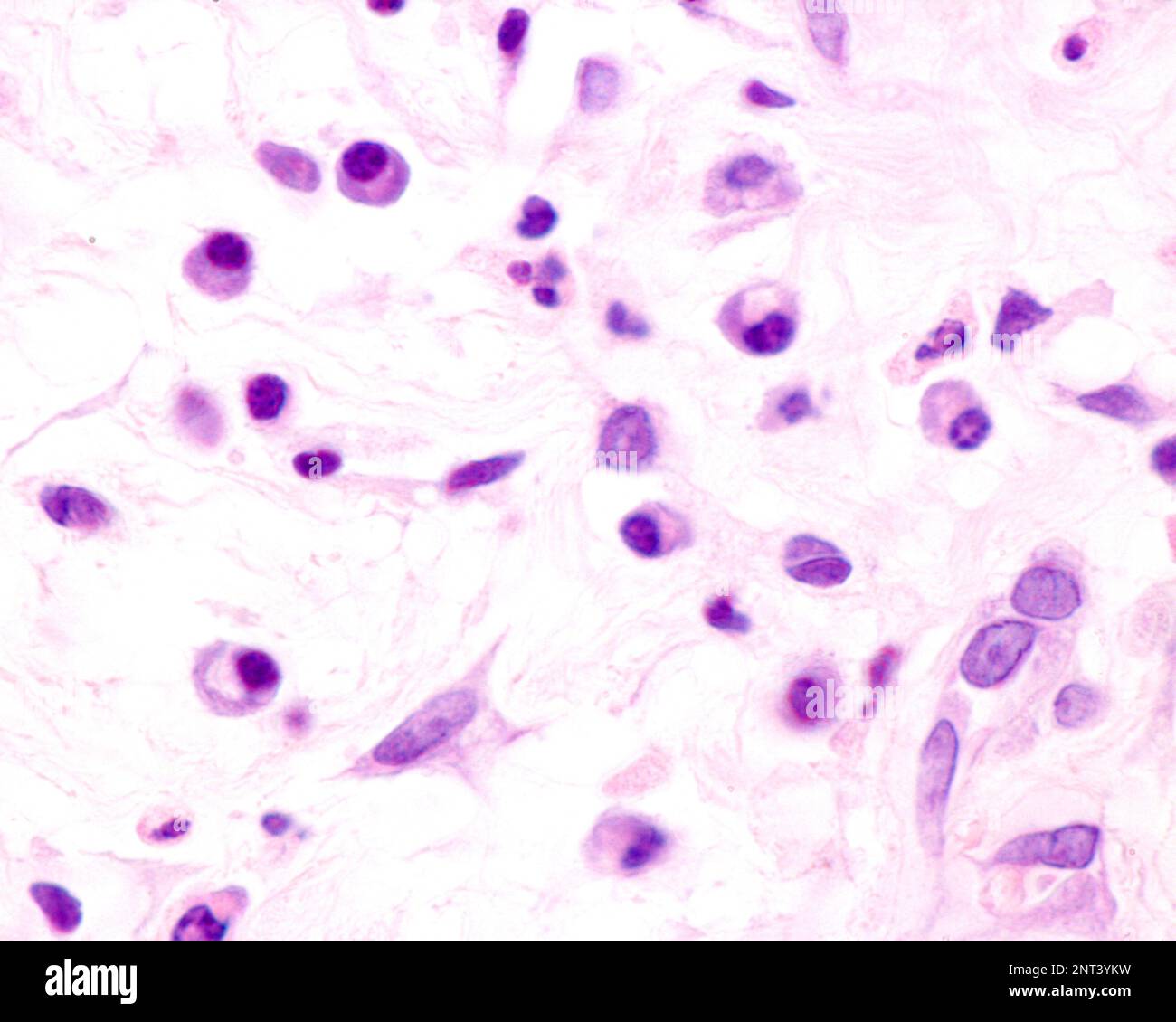 Le cellule plasmatiche sono linfociti B attivati dalla presenza di antigeni che secernono grandi quantità di anticorpi. Compaiono nei tessuti affetti da c Foto Stock