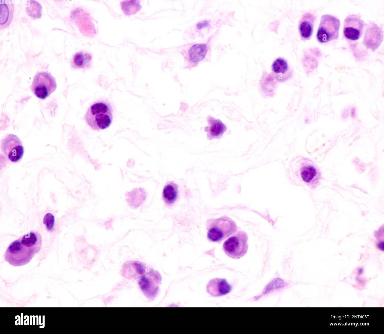 Le cellule plasmatiche sono linfociti B attivati dalla presenza di antigeni che secernono grandi quantità di anticorpi. Compaiono nei tessuti affetti da c Foto Stock