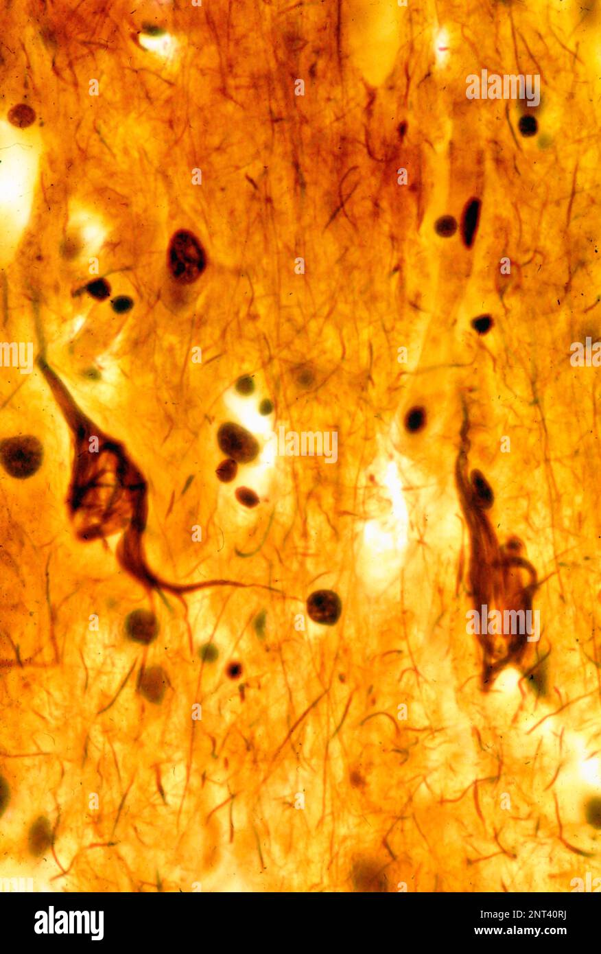 Micrografia leggera di una corteccia cerebrale umana che mostra grovigli neurofibrillari in due neuroni piramidali. I grovigli neurofibrillari (NFT) sono un carattere Foto Stock