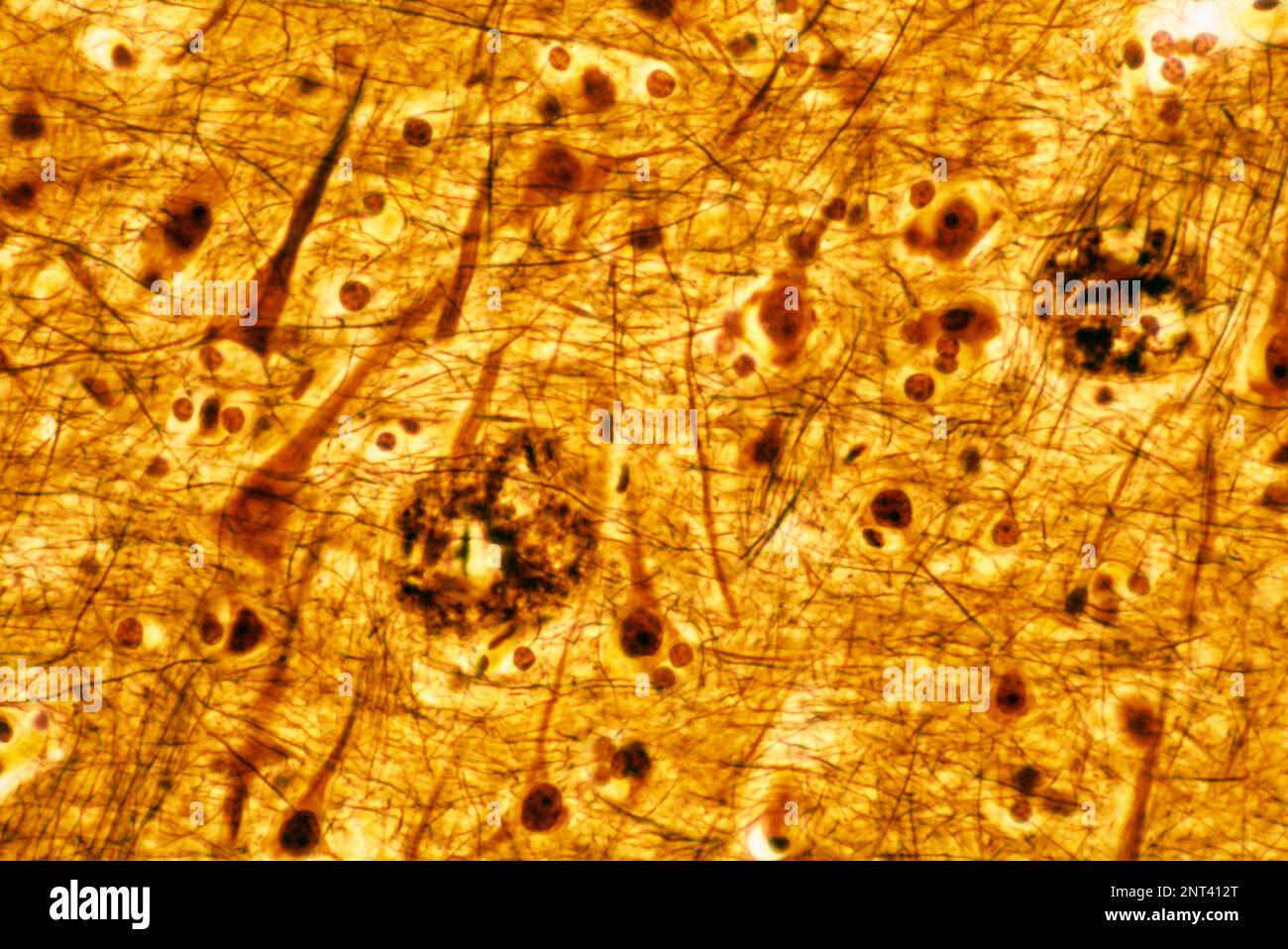 Micrografia al microscopio ottico di una corteccia cerebrale umana che mostra due placche senili, colorate con metodo dell'argento. Si tratta di depositi extracellulari di Am Foto Stock