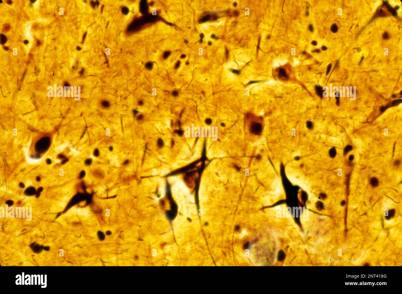 Micrografia leggera di una corteccia cerebrale umana che mostra grovigli neurofibrillari in diversi neuroni piramidali. I grovigli neurofibrillari (NFT) sono un caratto Foto Stock