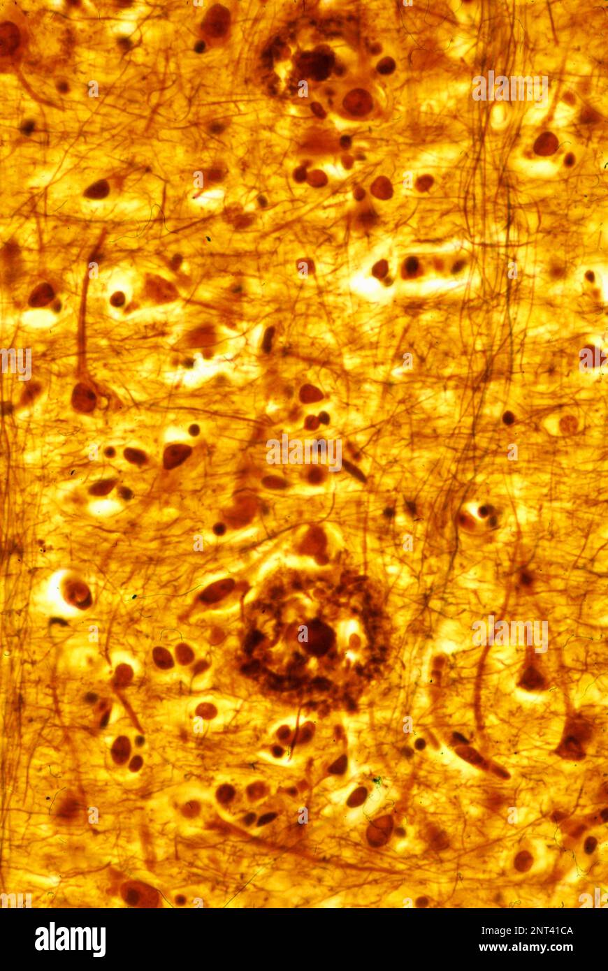 Micrografia al microscopio ottico di una corteccia cerebrale umana che mostra due placche senili, colorate con metodo dell'argento. Si tratta di depositi extracellulari di Am Foto Stock