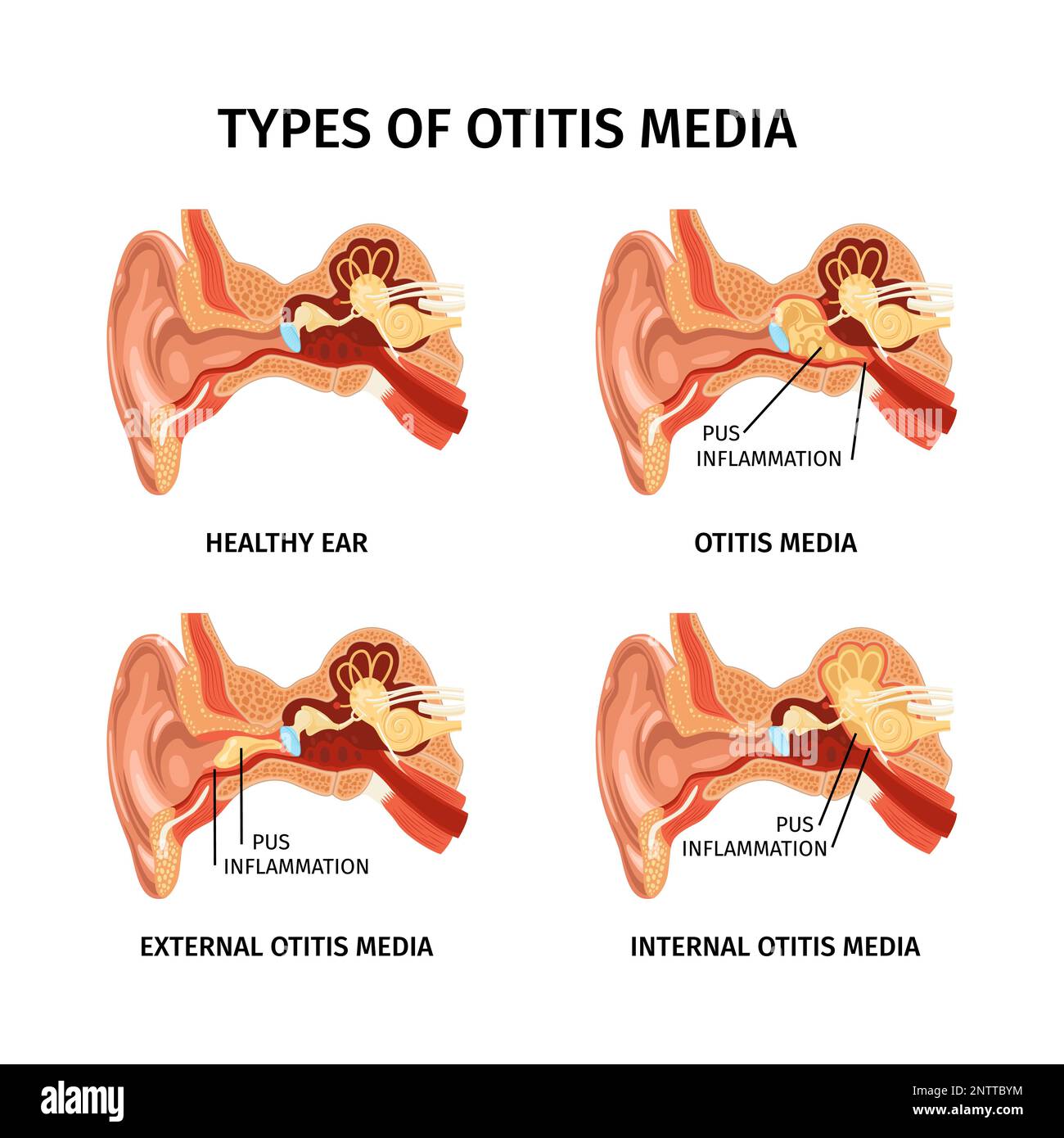 Anatomia realistica otite dell'orecchio insieme di quattro diagrammi anatomici isolati con didascalie di testo e illustrazione vettoriale degli organi interni Illustrazione Vettoriale