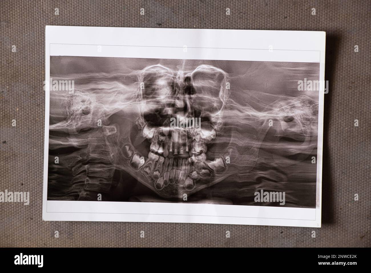 Una radiografia panoramica mostra diversi denti incastrati e impattati sulla mascella superiore e inferiore dei denti dei bambini Foto Stock