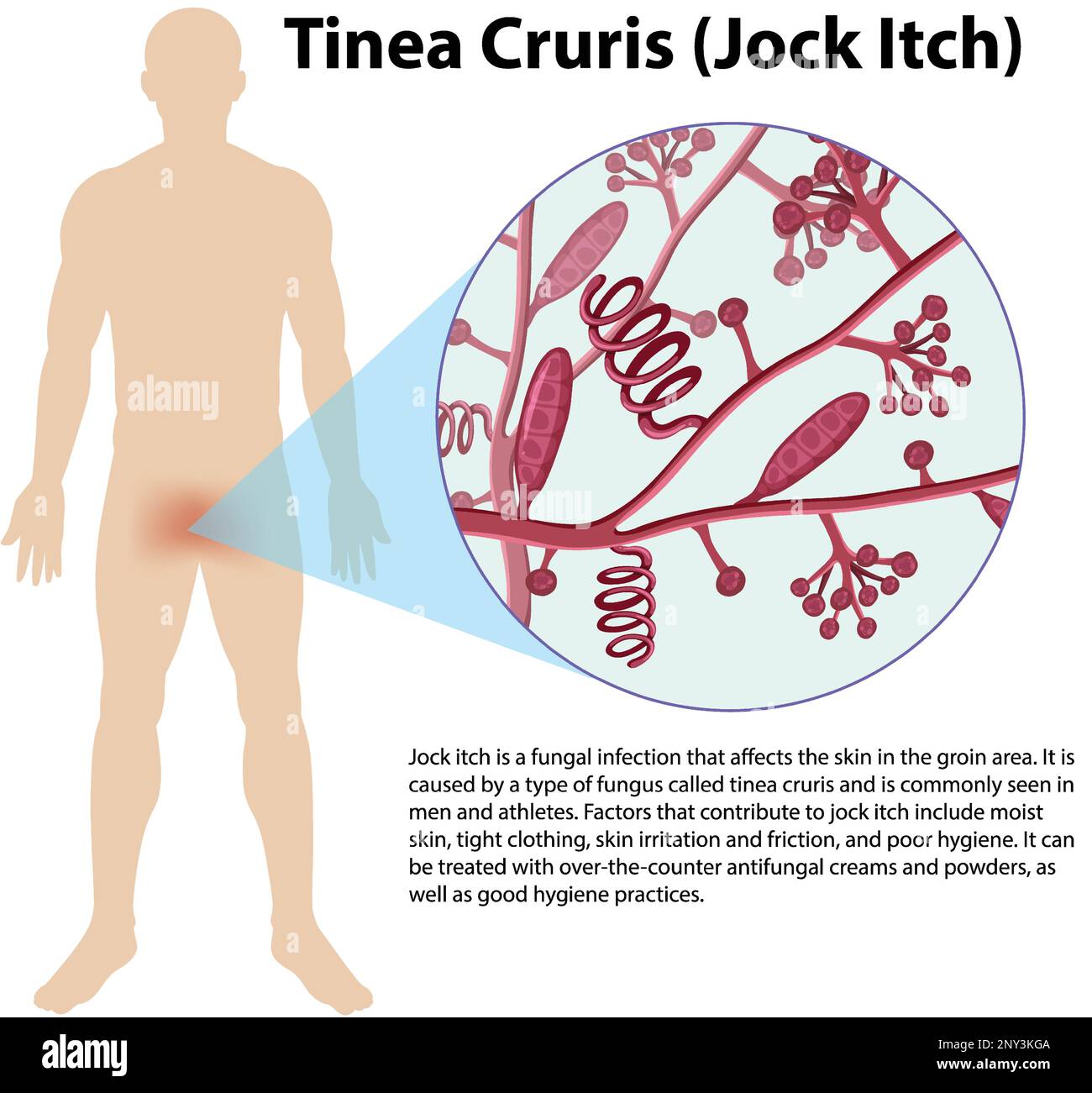 Trichophyton rubrum infezione fungal illustrazione Illustrazione Vettoriale