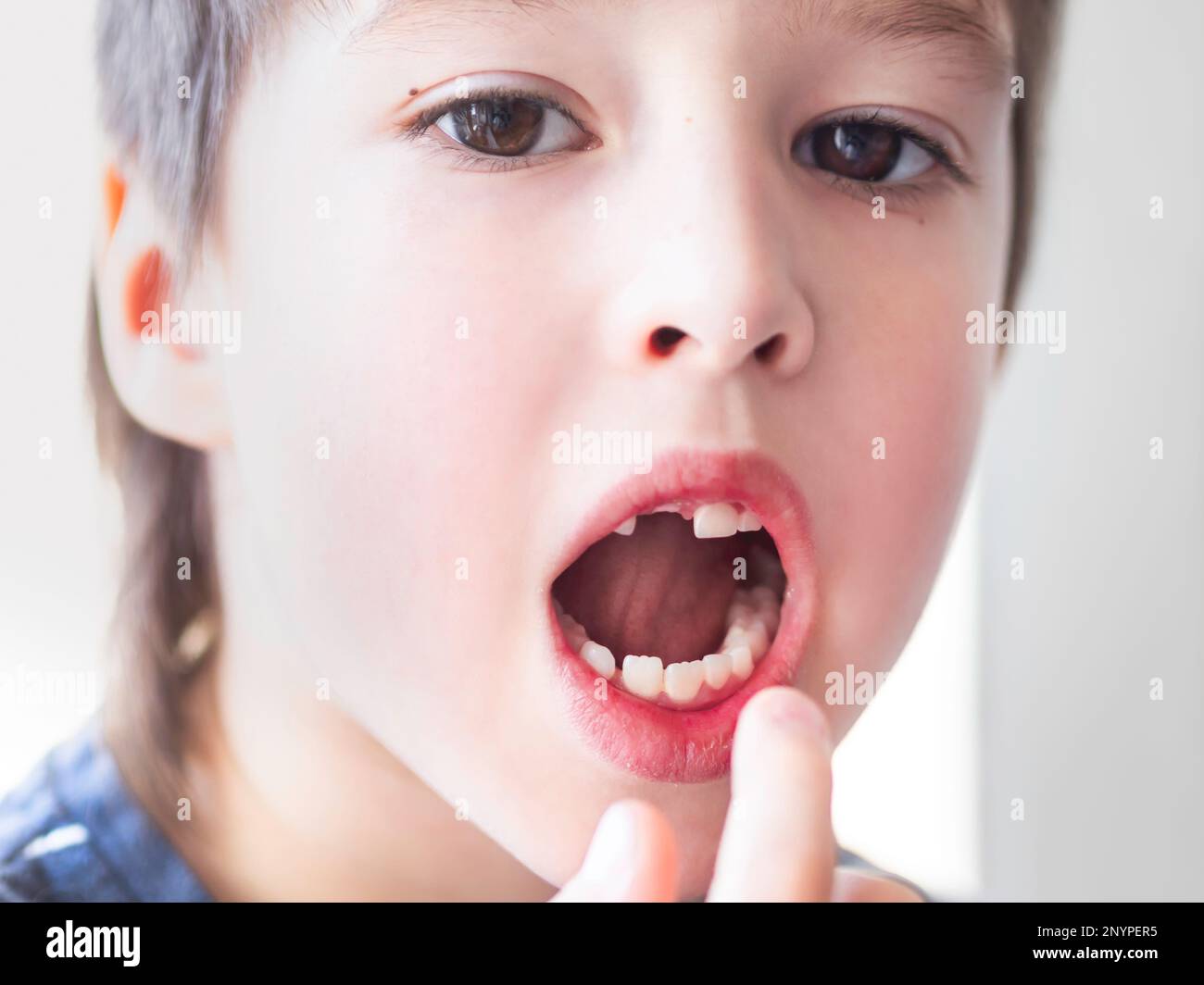 Il ragazzino mostra un buco in fila di denti in bocca. Un incisor è caduto fuori appena ora. Primo piano foto gengive per dentista. Foto Stock
