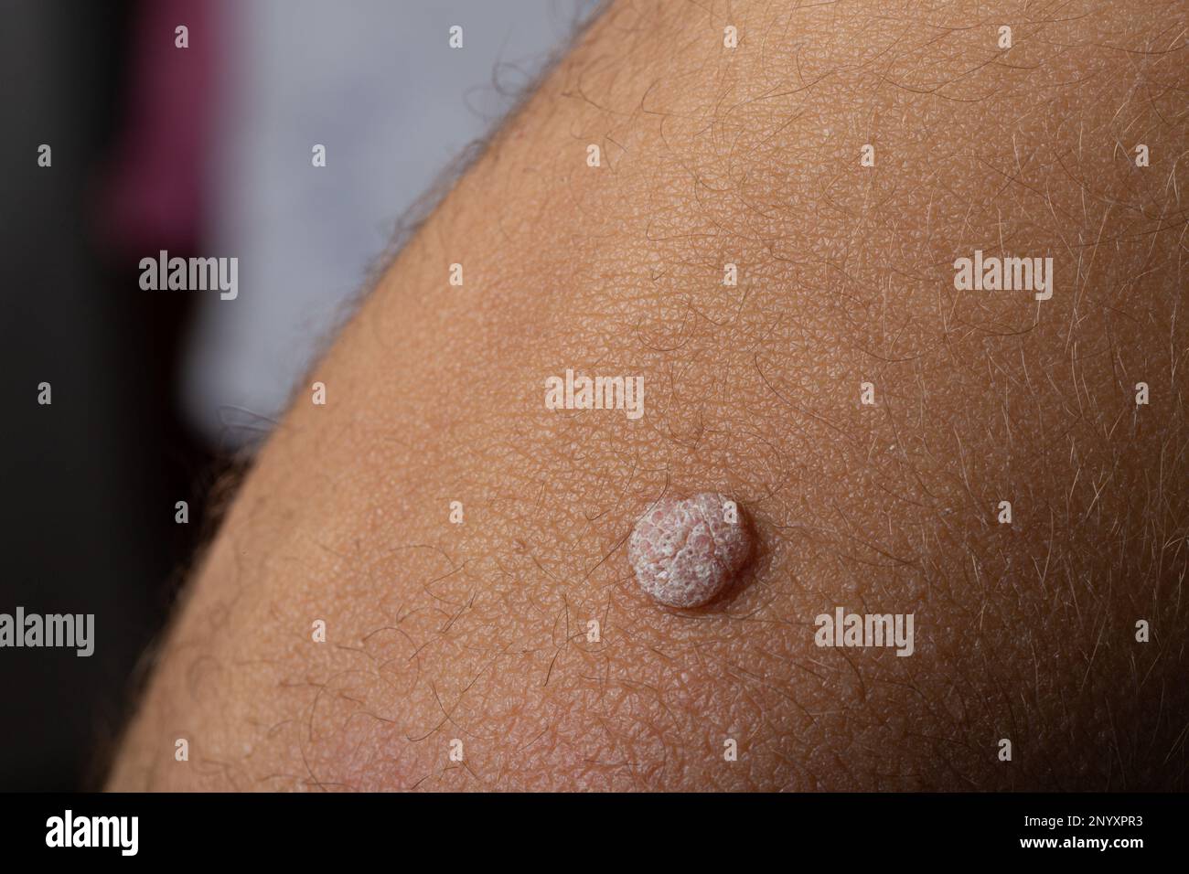 Immagine nitida di Wart on Arm Foto Stock