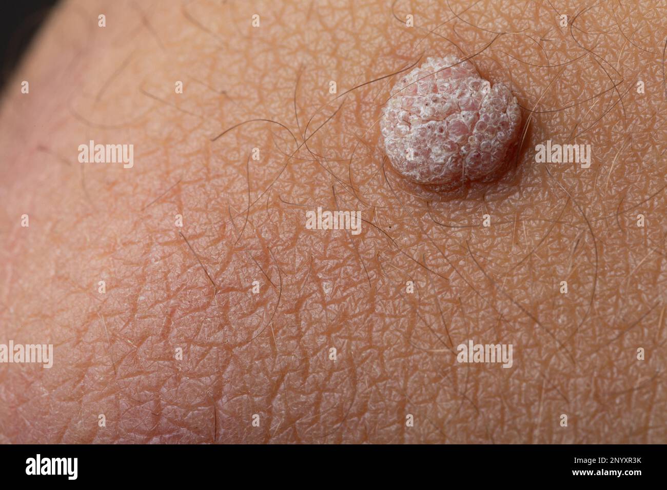 Primo piano di Wart on Boy's Arm Foto Stock