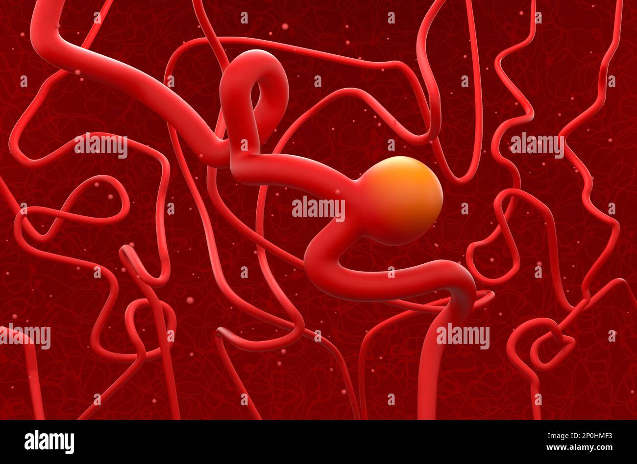 Aneurisma delle arterie cerebrali (aneurisma cerebrale) - vista isometrica dell'illustrazione 3D Foto Stock