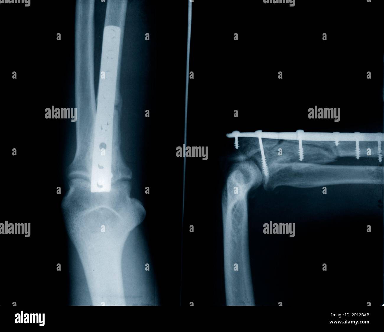 X-ray di frattura ulna - impianti con viti Foto Stock