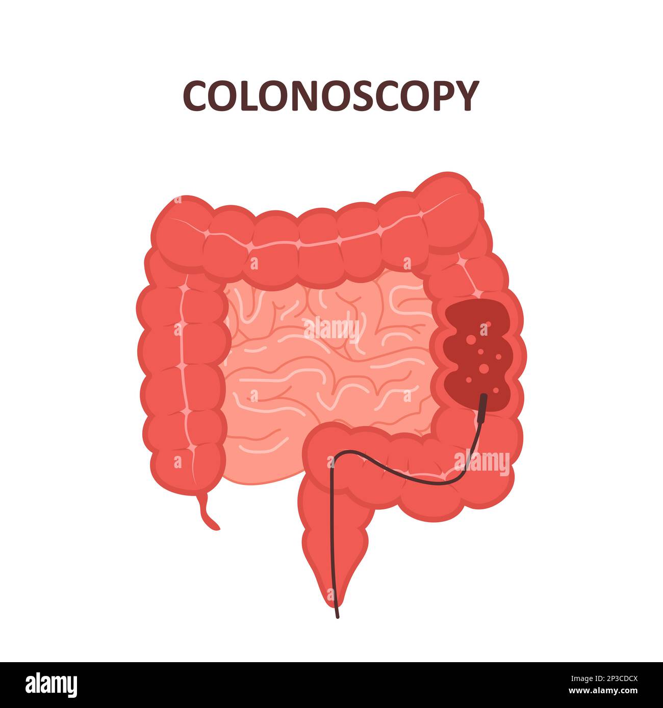 Procedura di colonscopia. Esame e trattamento dell'intestino. Concetto di polipectomia del colon. Prevenzione del cancro. Illustrazione vettoriale in stile cartoon piatto Illustrazione Vettoriale