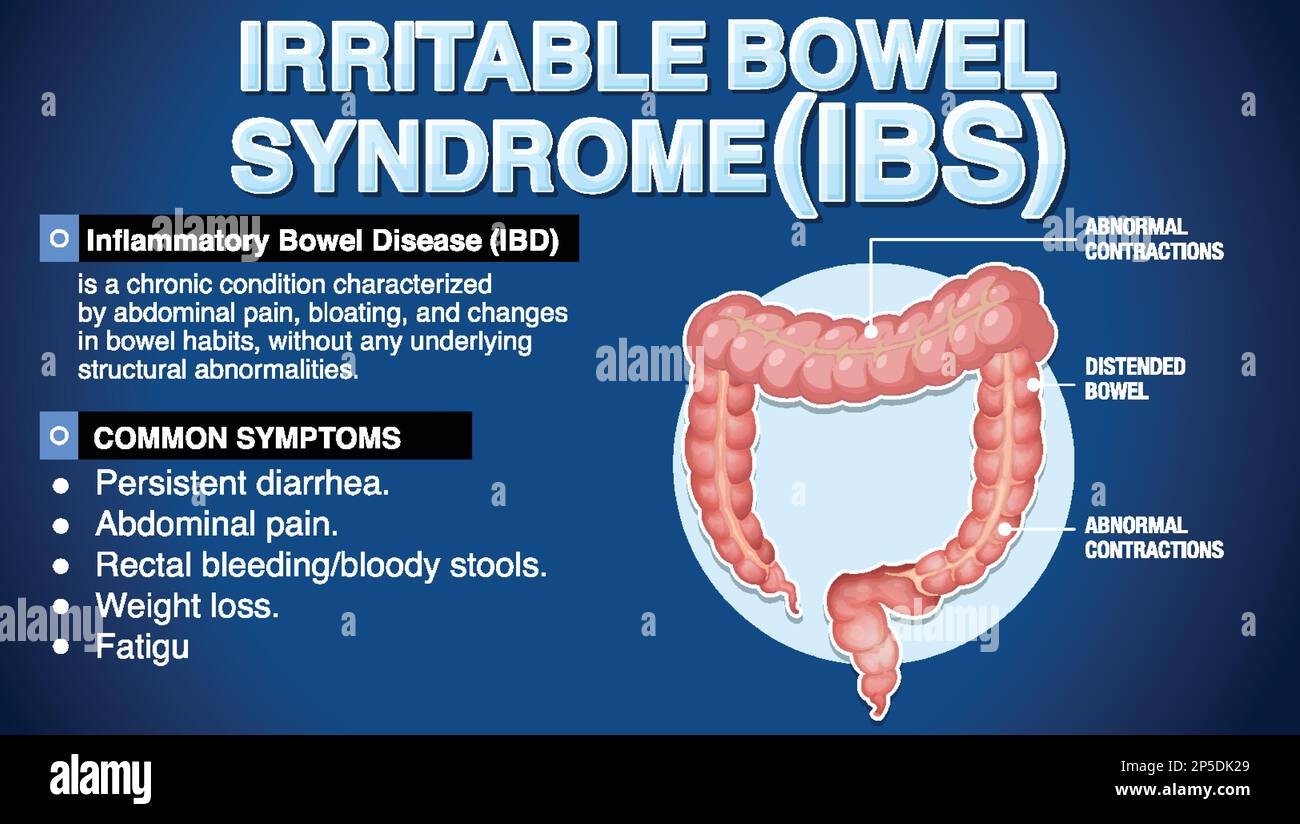 Illustrazione infografica della sindrome dell'intestino irritabile (IBS) Illustrazione Vettoriale