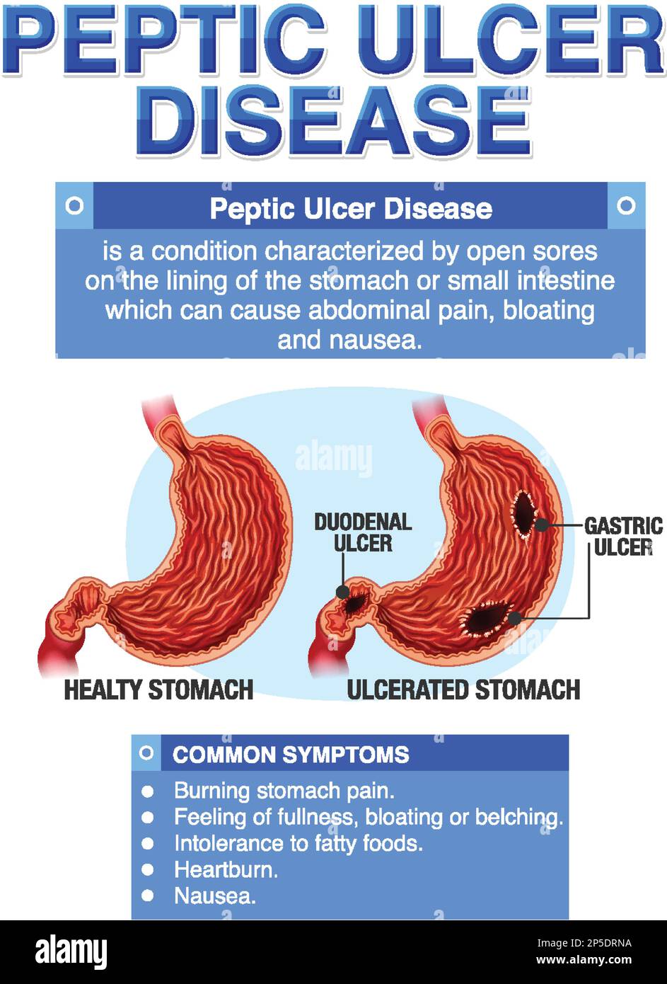 La malattia dell'ulcera peptica ha spiegato l'illustrazione infografica Illustrazione Vettoriale