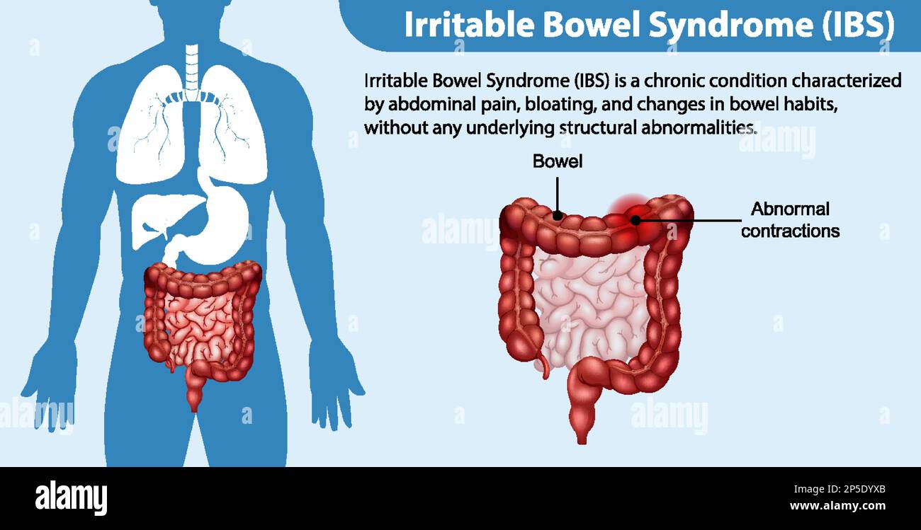 Illustrazione infografica della sindrome dell'intestino irritabile (IBS) Illustrazione Vettoriale