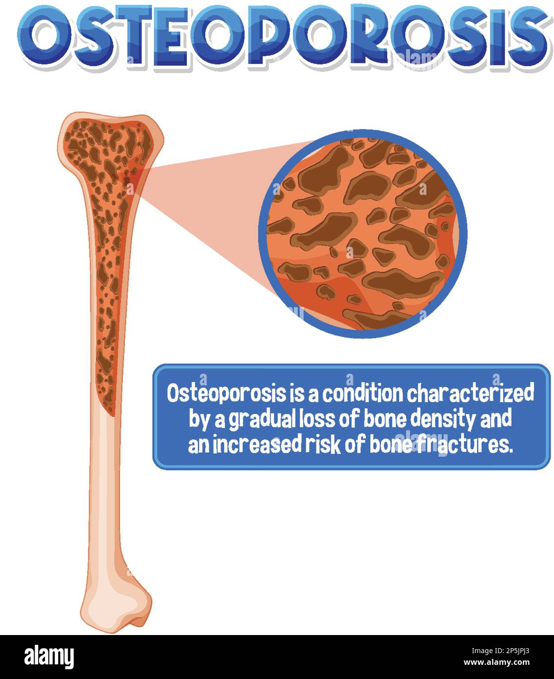 Poster informativo di Osteoporosi osso umano illustrazione Illustrazione Vettoriale