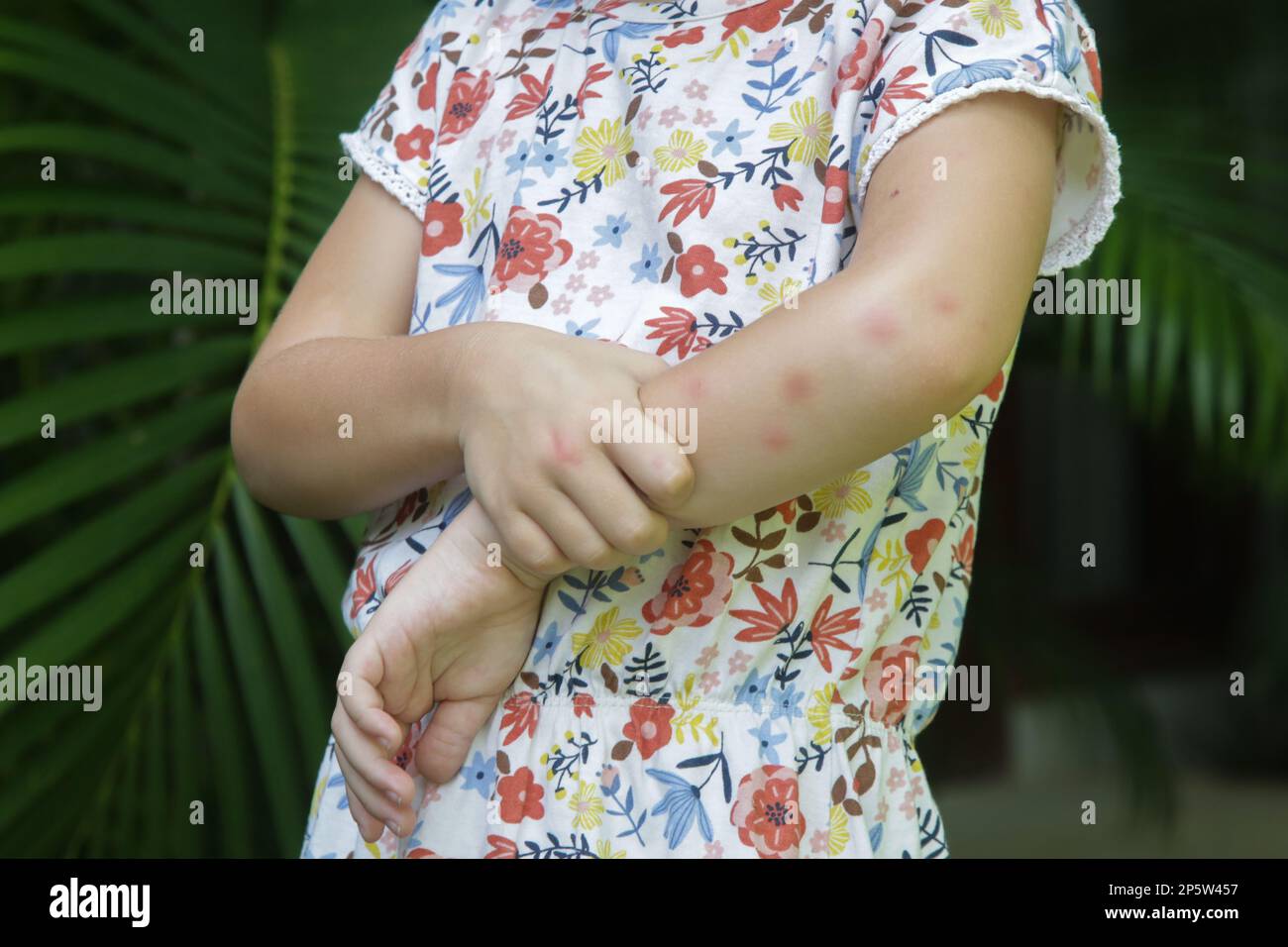 La bambina ha eruzione cutanea da allergia o morsi di zanzara Foto Stock