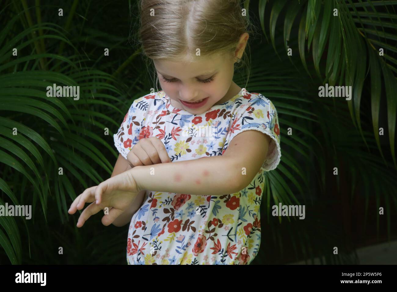 La bambina ha eruzione cutanea da allergia o morsi di zanzara Foto Stock