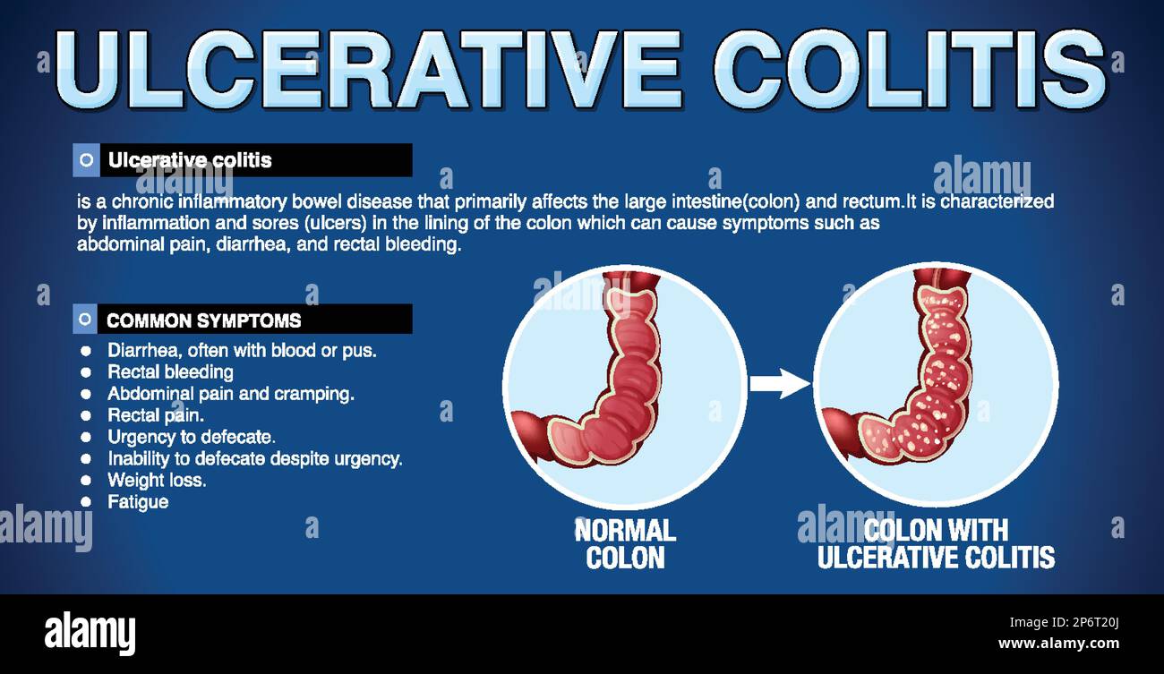 Sintomi della colite ulcerosa illustrazione infografica Illustrazione Vettoriale
