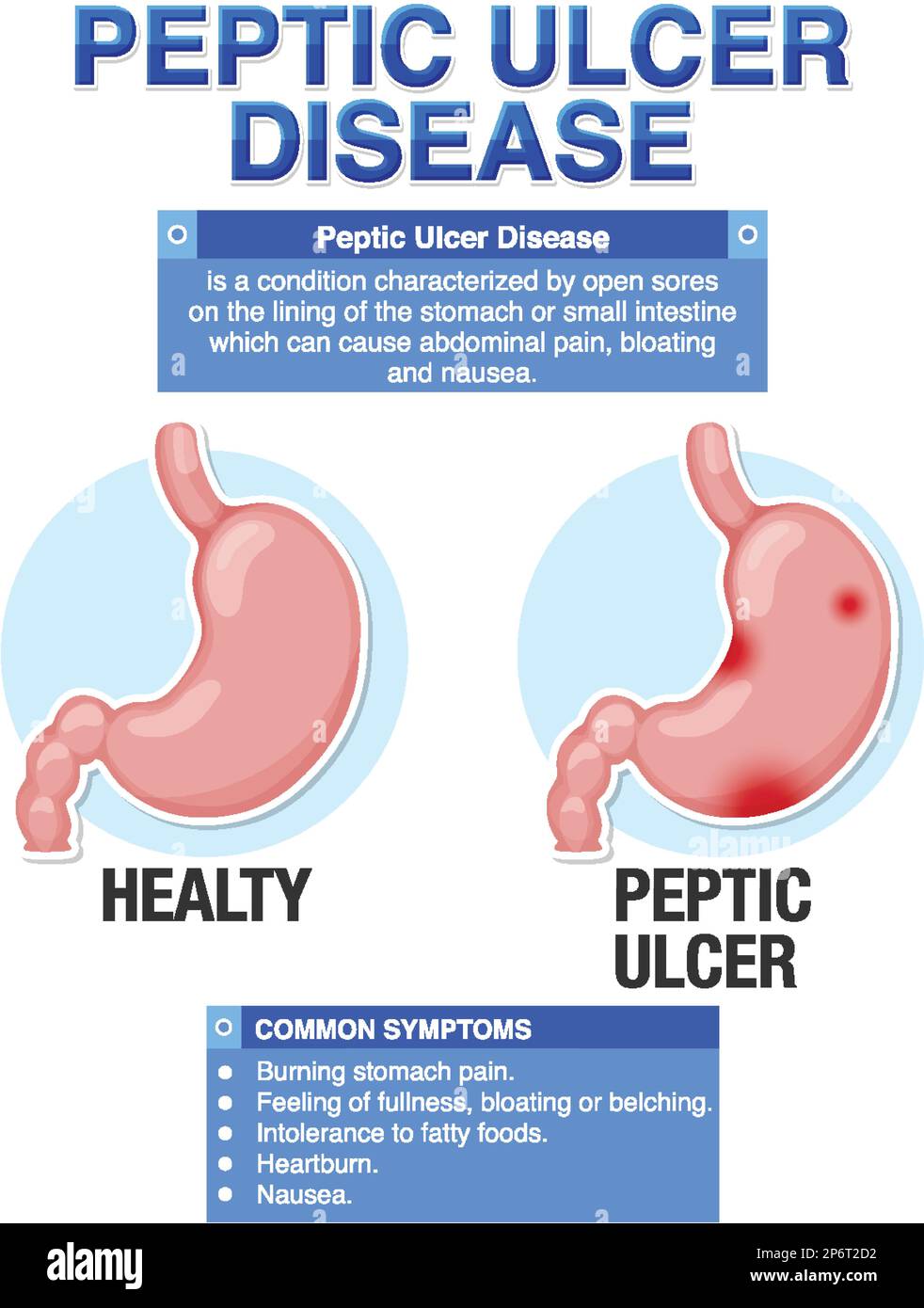 La malattia dell'ulcera peptica ha spiegato l'illustrazione infografica Illustrazione Vettoriale